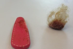 Bé gái mắc dị vật vùng kín ‘làm khó’ bác sĩ chẩn đoán 