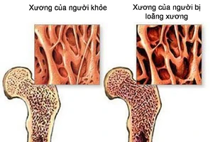 Người cao tuổi và bệnh xương khớp