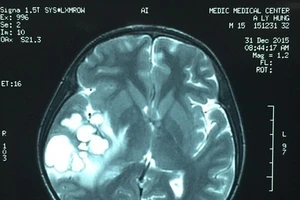 Nghi u não, mổ ra là ổ ấu trùng sán dải heo