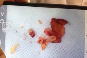 Gây mê và nội soi hai lần mới cứu được bé nuốt hạt ô môi