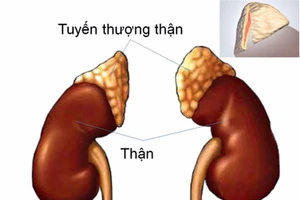 Bệnh nhi 4 ngày tuổi bị u tuyến thượng thận