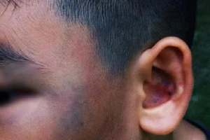 Đánh bé trai 8 tuổi đa chấn thương vì nghi trộm gà
