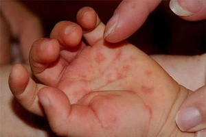 Bé 2 tuổi tử vong do mắc bệnh tay chân miệng