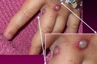 Ảnh: Bệnh viện Bệnh nhiệt đới