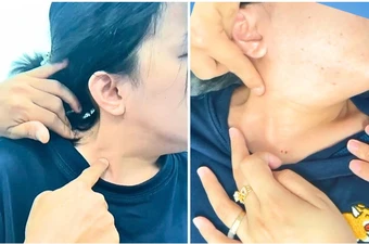 Cô gái 27 tuổi không thể quay cổ vì căn bệnh hiếm gặp