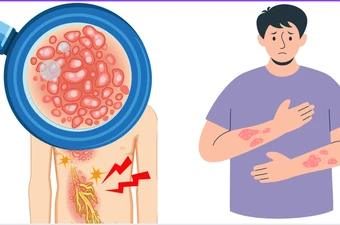 Vì sao người trên 50 tuổi có bệnh nền dễ gặp biến chứng do zona?