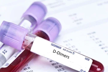 Đã tiêm vaccine AstraZeneca, có nên xét nghiệm D-dimer tìm cục máu đông?