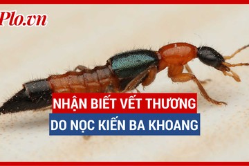 Sống vui khỏe: Nhận biết vết thương do nọc độc kiến ba khoang gây ra