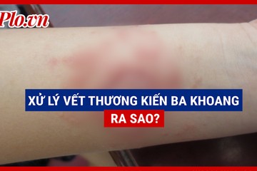 Video: Làm gì sau khi dính nọc kiến ba khoang?