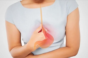 5 thói quen gây trào ngược dạ dày