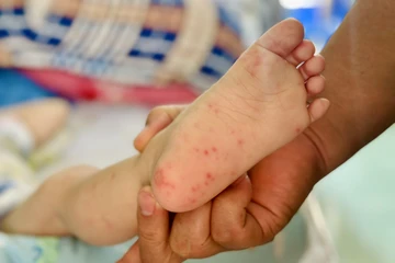 Tay chân miệng ở TP.HCM tăng cao, thêm 2 ca tử vong 