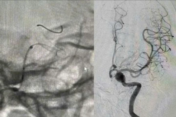 Can thiệp thành công ca bệnh có 'bom nổ chậm' trong não