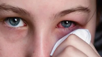 Mẹo nhỏ bỏ túi tránh viêm mắt, đỏ mắt trong mùa hè