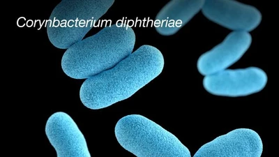 Các biến chứng nguy hiểm của bệnh bạch hầu, có thể gây tử vong