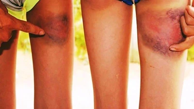 Làm gãy ghế, 6 học sinh bị thầy chủ nhiệm đánh bầm tím