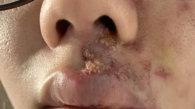 Mặt sưng phù, mưng mủ sau tiêm filler làm đầy rãnh má