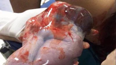 Kinh ngạc em bé xứ Nghệ ra đời trong bọc ối còn nguyên