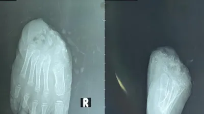 Bàn chân đứt lìa của bé trai 6 tuổi được cứu qua 5 lần phẫu thuật