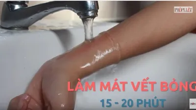 Mẹo hay - Dễ làm: 3 bước sơ cứu khi bị bỏng