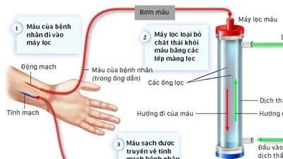 Quá trình chạy thận diễn ra như thế nào?