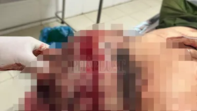 Đại úy Công an ở Bình Phước bị kẻ gây rối chém trọng thương 