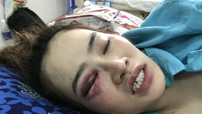 1 thanh niên đánh cô gái trong quán bánh xèo nhập viện