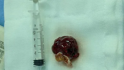 4 giờ phẫu thuật cứu người phụ nữ mang khối u trong tim