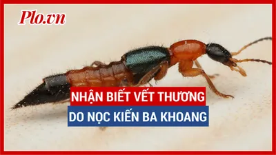 Sống vui khỏe: Nhận biết vết thương do nọc độc kiến ba khoang gây ra