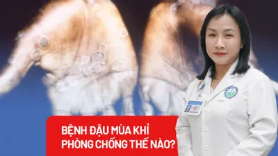 Xuất hiện ca đậu mùa khỉ, bác sĩ khuyến cáo gì?