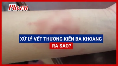 Video: Làm gì sau khi dính nọc kiến ba khoang?