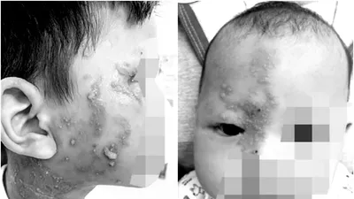 Bị kiến ba khoang cắn nhưng chẩn đoán mắc Zona, bác sĩ chỉ cách phân biệt