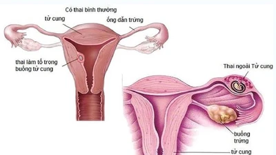 Suýt tử vong do dùng thuốc phá thai tại nhà