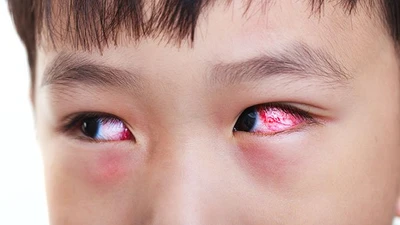 HCDC cảnh báo nguy cơ gia tăng bệnh truyền nhiễm mùa tựu trường