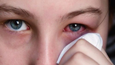 Mẹo nhỏ bỏ túi tránh viêm mắt, đỏ mắt trong mùa hè