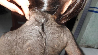 Kỳ lạ bé gái 5 tuổi mọc lông đầy mình như người sói