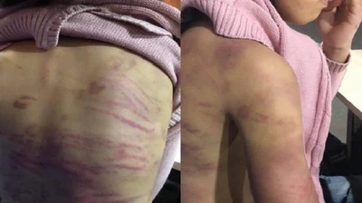 Cơ thể bé gái 12 tuổi với rất nhiều vết thương. Ảnh: GĐCC