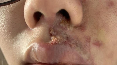 Mặt sưng phù, mưng mủ sau tiêm filler làm đầy rãnh má