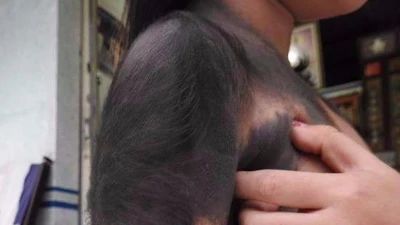 Cơ hội chữa bệnh miễn phí cho bé gái 'người sói' 