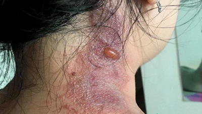 Viêm da tiếp xúc do kiến ba khoang nhưng bị 'phán' Zona thần kinh