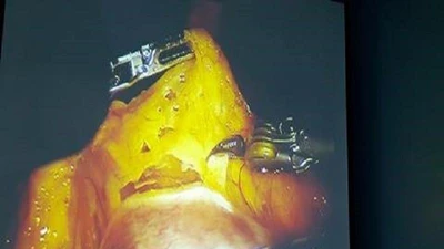 Lần đầu tiên dùng robot phẫu thuật ung thư dạ dày