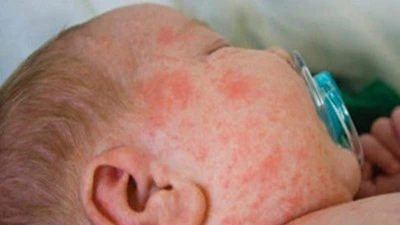 Dịch sởi bùng phát, lan rộng 43 tỉnh thành