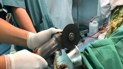 Bác sĩ cưa máy xay thịt giải cứu bàn tay cho bệnh nhân