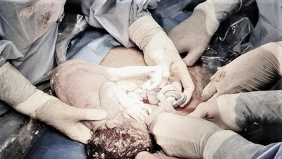 Cứu sống song thai với dây rốn xoắn lò xo, thắt nút nhiều lần