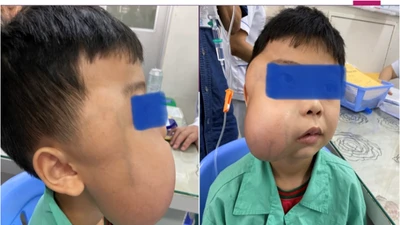 Căn bệnh khiến hàm bé trai sưng to, chảy máu mũi nhiều năm