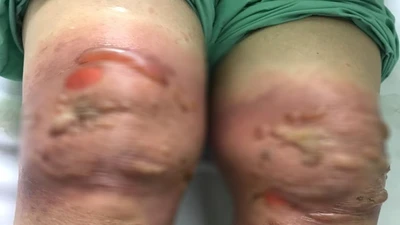 Sưng nề, phỏng rộp toàn bộ 2 khớp gối vì đắp lá thuốc xào giấm