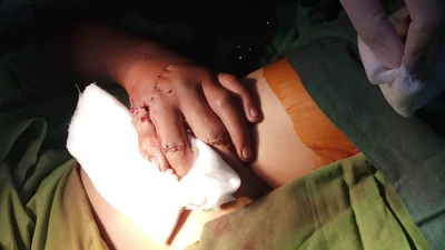 Bệnh nhi suýt bị cắt bỏ bàn tay vì đốt pháo nổ tự chế