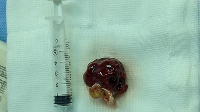 4 giờ phẫu thuật cứu người phụ nữ mang khối u trong tim