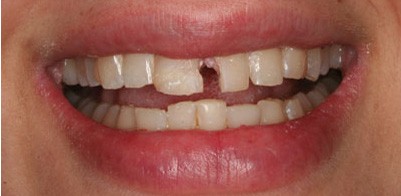 Có những biện pháp nào để tái tạo răng sau khi bị mẻ?