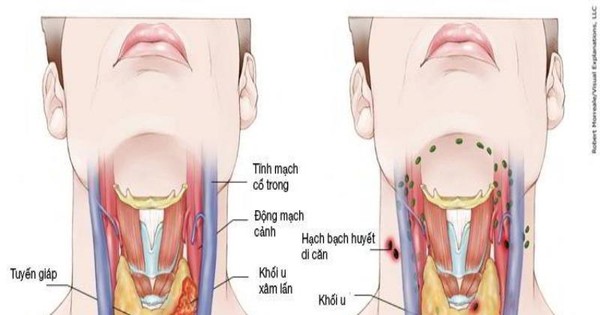 Mô hình giải phẫu họng bình thường và bệnh lý