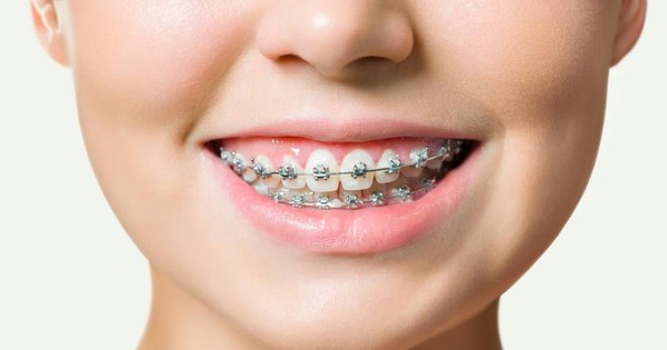 Có phương pháp niềng răng nhanh chóng hơn không?

